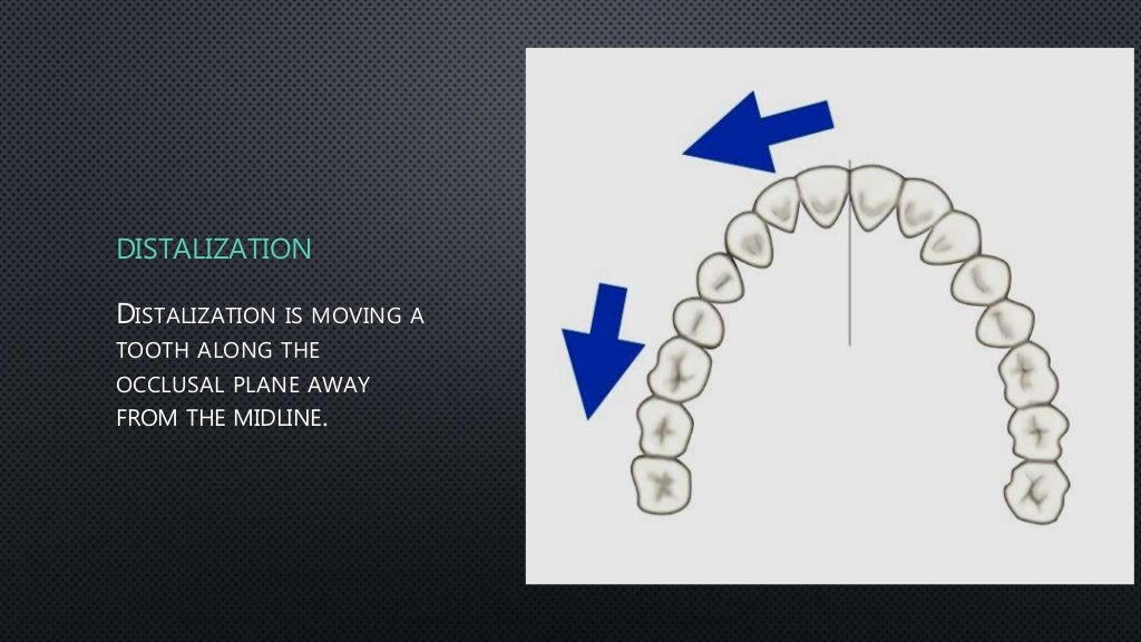 Orthodontic Tooth movement types