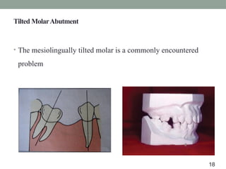 • The mesiolingually tilted molar is a commonly encountered
problem
Tilted MolarAbutment
18
 