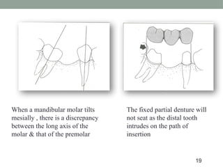 When a mandibular molar tilts
mesially , there is a discrepancy
between the long axis of the
molar & that of the premolar
The fixed partial denture will
not seat as the distal tooth
intrudes on the path of
insertion
19
 