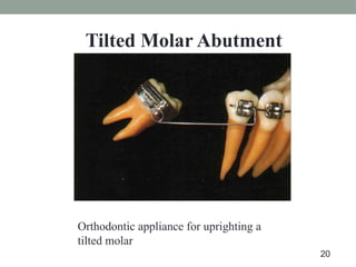 Orthodontic appliance for uprighting a
tilted molar
Tilted Molar Abutment
20
 