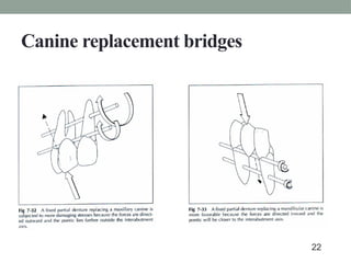 Canine replacement bridges
22
 