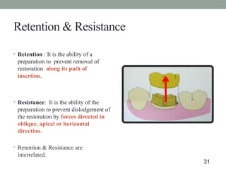 Retention & Resistance
• Retention : It is the ability of a
preparation to prevent removal of
restoration along its path of
insertion.
• Resistance: It is the ability of the
preparation to prevent dislodgement of
the restoration by forces directed in
oblique, apical or horizontal
direction.
• Retention & Resistance are
interrelated.
31
 