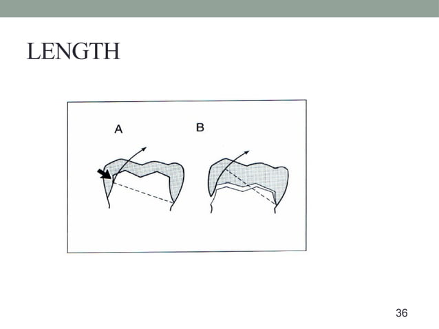 tooth preparation and it's modifications | PPT