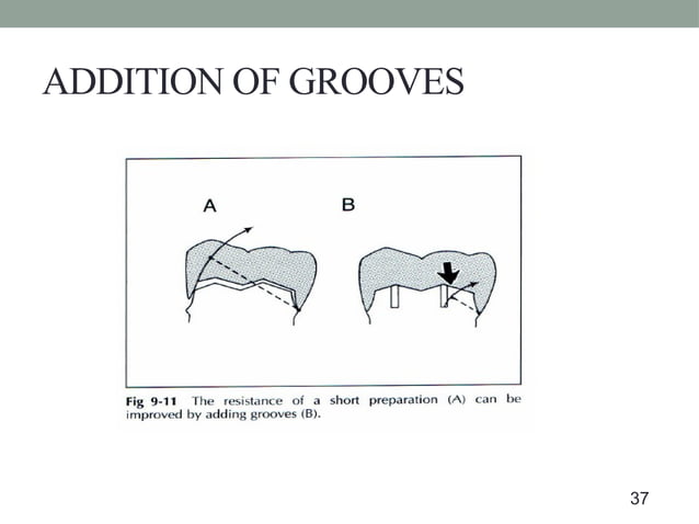 tooth preparation and it's modifications | PPT