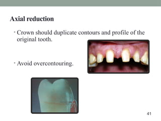 Axial reduction
• Crown should duplicate contours and profile of the
original tooth.
• Avoid overcontouring.
41
 