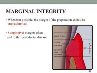 MARGINALINTEGRITY
• Whenever possible, the margin of the preparation should be
supragingival.
• Subgingival margins often
lead to the periodontal disease
42
 