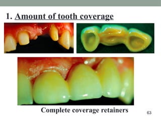 Complete coverage retainers
1. Amount of tooth coverage
63
 