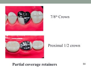 7/8th
Crown
Proximal 1/2 crown
Partial coverage retainers 64
 