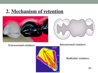 2. Mechanism of retention
Extracoronal retainers Intracoronal retainers
Radicular retainers
65
 
