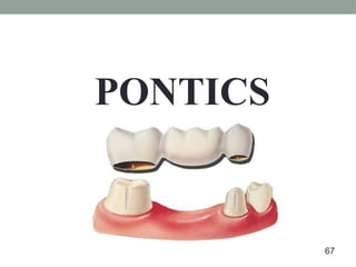 PONTICS
67
 