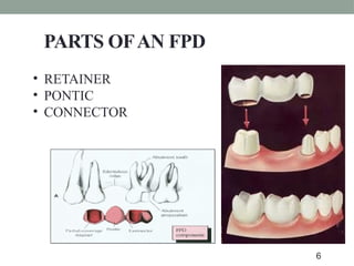 PARTS OFAN FPD
• RETAINER
• PONTIC
• CONNECTOR
6
 