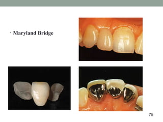 • Maryland Bridge
75
 