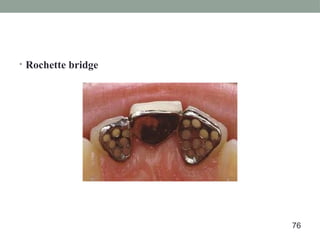 • Rochette bridge
76
 