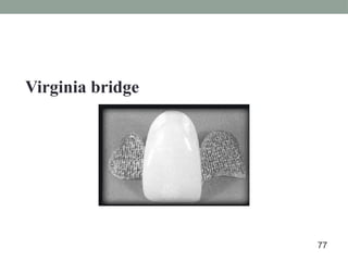 Virginia bridge
77
 