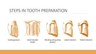 TOOTH PREPARATION FULL VENEER ANTERIOR PFM PPTX