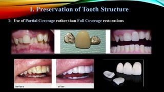 Tooth preparation part 1