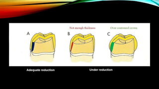 Tooth preparation part 1