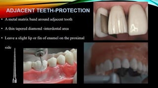 Tooth preparation part 1
