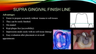 Tooth preparation part 1