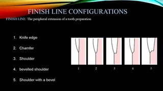Tooth preparation part 1