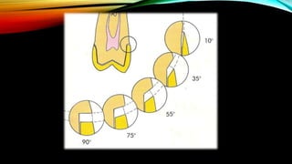 Tooth preparation part 1