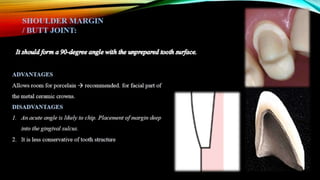 Tooth preparation part 1