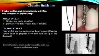 Tooth preparation part 1