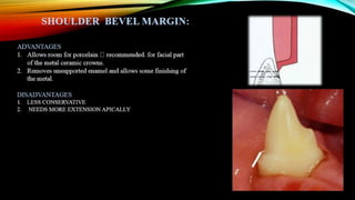 Tooth preparation part 1
