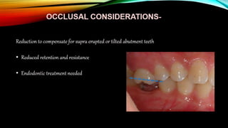 Tooth preparation part 1