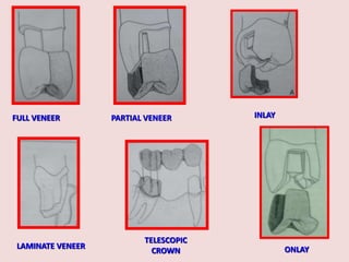 FULL VENEER PARTIAL VENEER
ONLAY
INLAY
LAMINATE VENEER
TELESCOPIC
CROWN
 