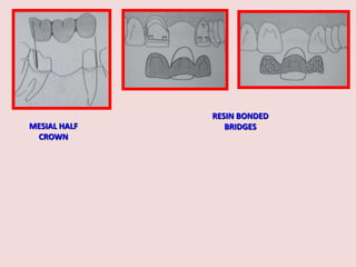 MESIAL HALF
CROWN
RESIN BONDED
BRIDGES
 