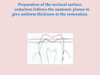 Preparation of the occlusal surface:
reduction follows the anatomic planes to
give uniform thickness to the restoration.
 