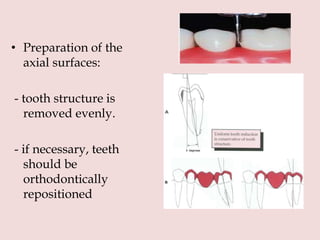 • Preparation of the
axial surfaces:
- tooth structure is
removed evenly.
- if necessary, teeth
should be
orthodontically
repositioned
 