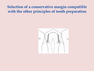 Selection of a conservative margin compatible
with the other principles of tooth preparation
 
