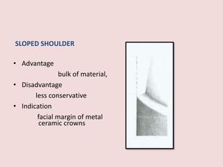 SLOPED SHOULDER
• Advantage
bulk of material,
• Disadvantage
less conservative
• Indication
facial margin of metal
ceramic crowns
 