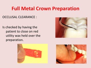 Full Metal Crown Preparation
OCCLUSAL CLEARANCE :
Is checked by having the
patient to close on red
utility wax held over the
preparation.
 