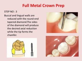 Full Metal Crown Prep
STEP NO : 3
Buccal and lingual walls are
reduced with the round-end
tapered diamond.The sides
of the diamond will produce
the desired axial reduction
while the tip forms the
chamfer.
 