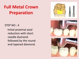 Full Metal Crown
Preparation
STEP NO : 4
Initial proximal axial
reduction with short
needle diamond
followed by the round-
end tapered diamond.
 