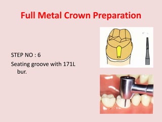 Full Metal Crown Preparation
STEP NO : 6
Seating groove with 171L
bur.
 