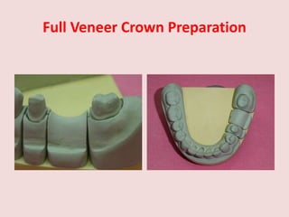 Full Veneer Crown Preparation
 