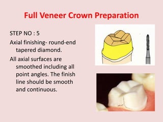 Full Veneer Crown Preparation
STEP NO : 5
Axial finishing- round-end
tapered diamond.
All axial surfaces are
smoothed including all
point angles. The finish
line should be smooth
and continuous.
 
