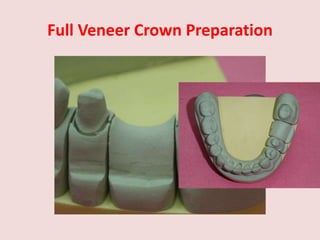 Full Veneer Crown Preparation
 