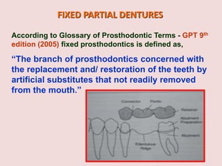 FIXED PARTIAL DENTURES
According to Glossary of Prosthodontic Terms - GPT 9th
edition (2005) fixed prosthodontics is defined as,
“The branch of prosthodontics concerned with
the replacement and/ restoration of the teeth by
artificial substitutes that not readily removed
from the mouth.”
 