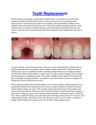 Tooth Replacement
Dental implants can replace a single tooth, multiple teeth, or an entire arch of teeth. Once
implants are placed and allowed to heal for a short period of time, the prosthesis(tooth
replacement) is connected to the implant via an anchor called an abutment. Modern dental
implants require far shorter healing times (4-6 weeks) than traditional dental implants, which
required up to six months of healing. Implants can also be placed immediately into the area
where a tooth has been extracted and can often have temporary teeth attached the same day of
surgery.
A single missing, or soon-to-be-missing, tooth can be easily and predictably replaced with an
implant-retained crown. An implant crown is highly esthetic and will feel and function like a
natural tooth. There are multiple benefits to choosing dental implant over a bridge to replace
missing teeth. When used to replace a single tooth, an implant, unlike a bridge, will not require
the shaving-down of neighboring teeth. Also unlike a bridge, dental implant will maintain the
bone around the missing tooth intact. An implant is also much easier to clean as compared to a
bridge and will not be affected by cavities.
When replacing multiple teeth, dental implants can be used to support implant-bridges that are
permanently fixed in your mouth and will not move around like partials or dentures. Because
dental implants replace the roots of the missing natural teeth, they preserve the jawbone and
prevent bone deterioration. This preservation of jawbone helps to keep both the bone and gum
tissue from collapsing, a process that can give denture patients a prematurely aged, “sunken-in”
look. With a traditional bridge, the cement that glues the bridge to the teeth will “wash-out” from
underneath the bridge. This exposes the tooth, allowing cavities to form. Unlike a traditional
bridge, dental implants do not get cavities, nor do they weaken adjacent teeth.
 