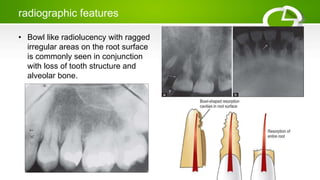 radiographic features
• Bowl like radiolucency with ragged
irregular areas on the root surface
is commonly seen in conjunction
with loss of tooth structure and
alveolar bone.
 