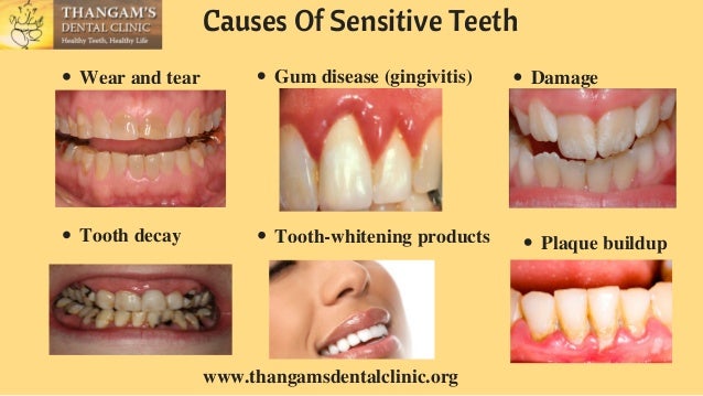 Tooth Sensitive To Hot And Cold Drinks Tooth Sensitive To Hot And Cold Drinks