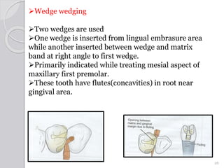 Tooth seperation matrix wedges amjath | PPTX