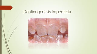 Dentinogenesis Imperfecta
 