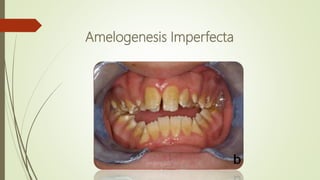 Amelogenesis Imperfecta
 