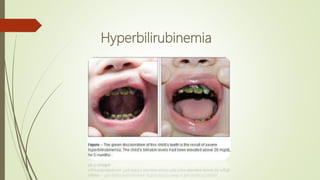 Hyperbilirubinemia
 